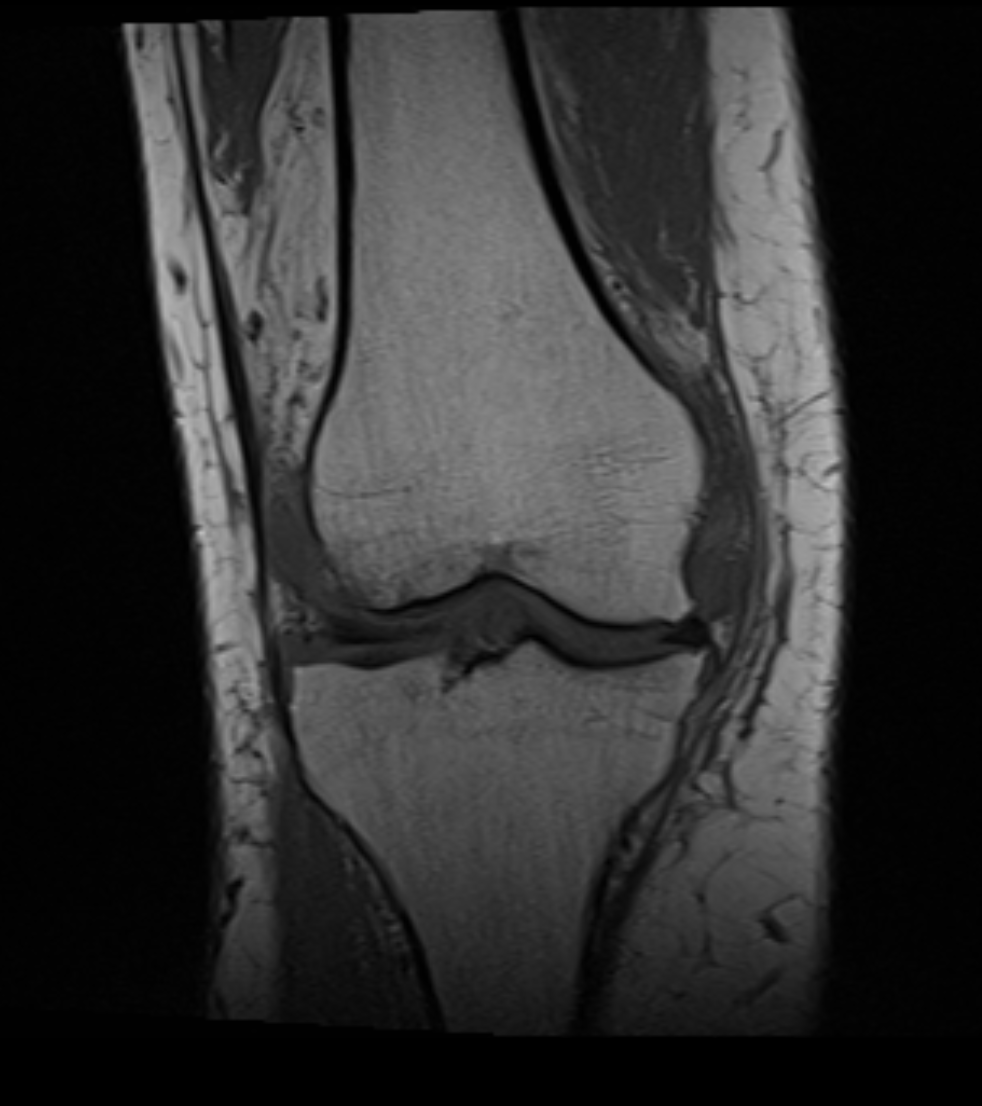 MRI kolano – podstawowy