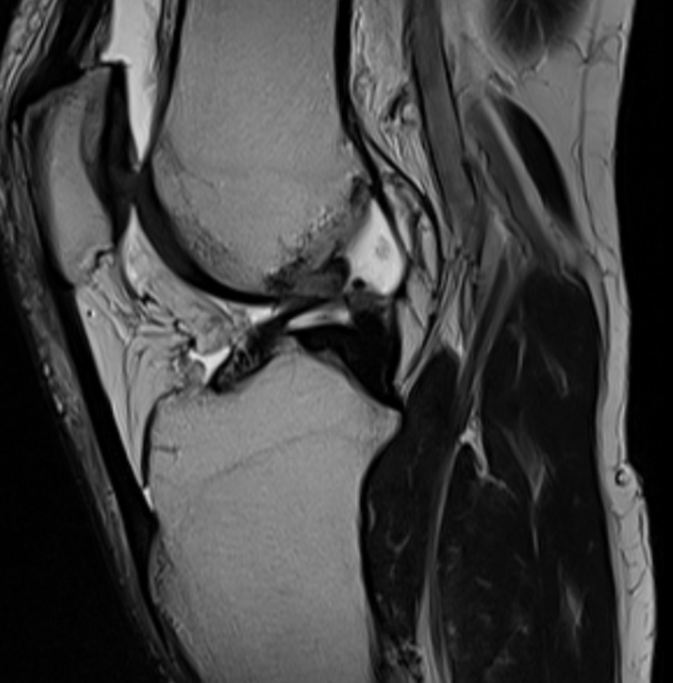 MRI kolano – średnio zaawansowany